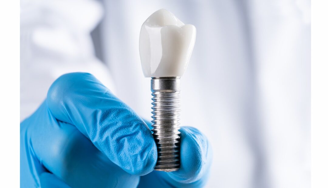 tomografia odontologica e implante dentario
